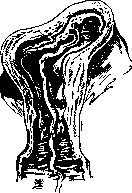 Breech Presentation: figure 52 from the 1928–1936 encyclopedia article
