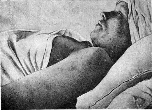 Breech Presentation: figure 53 from the 1928–1936 encyclopedia article