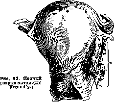 Breech Presentation: figure 58 from the 1928–1936 encyclopedia article