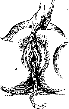 Breech Presentation: figure 22 from the 1928–1936 encyclopedia article