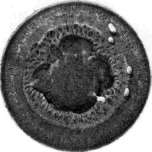 Iritis: figure 4 from the 1928–1936 encyclopedia article