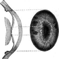 Iritis: figure 3 from the 1928–1936 encyclopedia article