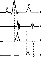 Cardiac Arrhythmias: figure 2 from the 1928–1936 encyclopedia article