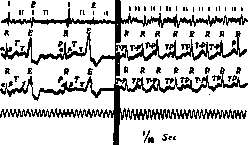 Cardiac Arrhythmias: figure 9 from the 1928–1936 encyclopedia article