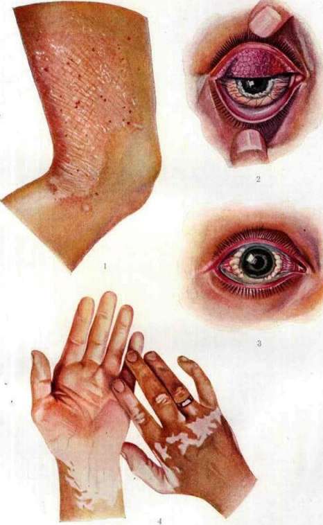 Spring Catarrh: figure 1 from the 1928–1936 encyclopedia article