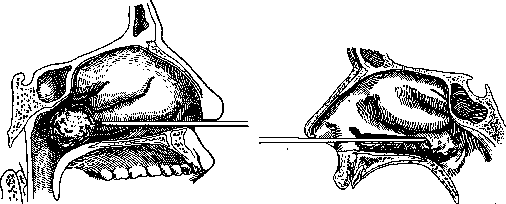 Rhinitis: figure 5 from the 1928–1936 encyclopedia article
