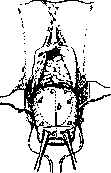 Hysterostomatomia Sub Partu: figure 1 from the 1928–1936 encyclopedia article
