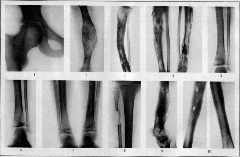 Osteomyelitis: figure 1 from the 1928–1936 encyclopedia article