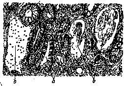 Gastritis: figure 1 from the 1928–1936 encyclopedia article