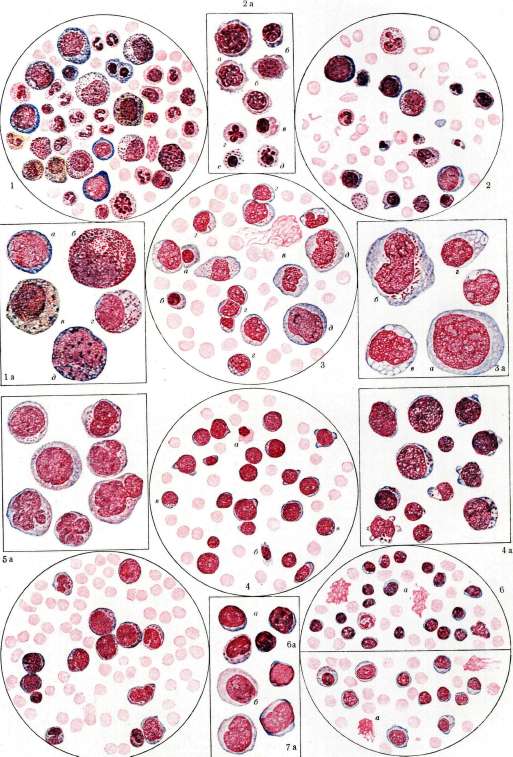 Leukemia: figure 1 from the 1928–1936 encyclopedia article