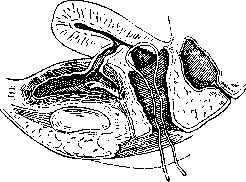 Hysterocleisis: figure 2 from the 1928–1936 encyclopedia article