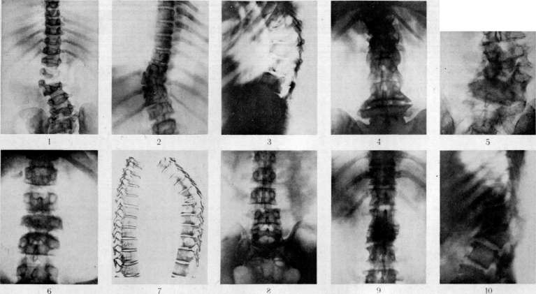 Vertebral Column: figure 32 from the 1928–1936 encyclopedia article