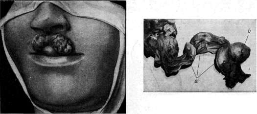 Sideroscope: figure 3 from the 1928–1936 encyclopedia article