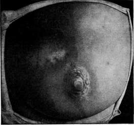 Sideroscope: figure 4 from the 1928–1936 encyclopedia article