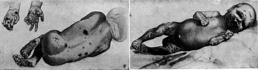 Sideroscope: figure 5 from the 1928–1936 encyclopedia article