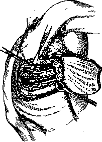 Cardiolysis: figure 1 from the 1928–1936 encyclopedia article