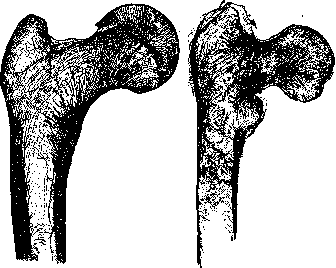 Osteomalacia: figure 2 from the 1928–1936 encyclopedia article
