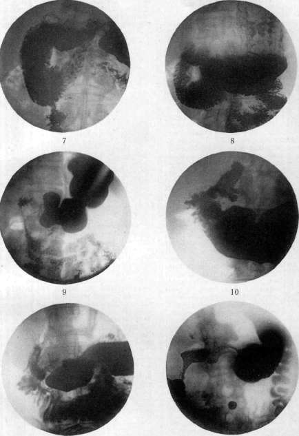Duodenum: figure 21 from the 1928–1936 encyclopedia article