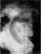 Duodenum: figure 20 from the 1928–1936 encyclopedia article