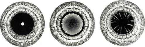 Cataract: figure 2 from the 1928–1936 encyclopedia article