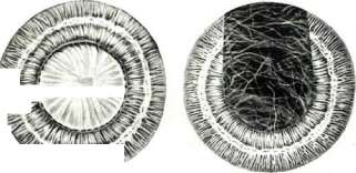 Cataract: figure 4 from the 1928–1936 encyclopedia article