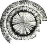 Cataract: figure 3 from the 1928–1936 encyclopedia article