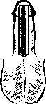 Hypospadias: figure 10 from the 1928–1936 encyclopedia article
