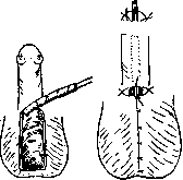 Hypospadias: figure 14 from the 1928–1936 encyclopedia article
