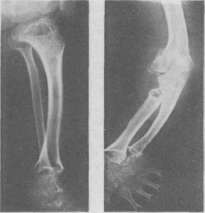 Arteriosclerosis: figure 7 from the 1928–1936 encyclopedia article