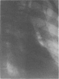 Arteriosclerosis: figure 4 from the 1928–1936 encyclopedia article