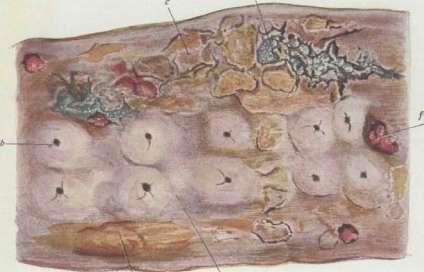 Arteriosclerosis: figure 2 from the 1928–1936 encyclopedia article