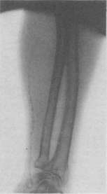 Arteriosclerosis: figure 5 from the 1928–1936 encyclopedia article