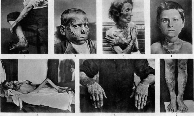 Pellagra: figure 2 from the 1928–1936 encyclopedia article