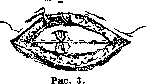 Gilliam-Doleri Operation: figure 3 from the 1928–1936 encyclopedia article