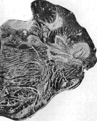 Multiple Sclerosis: figure 3 from the 1928–1936 encyclopedia article