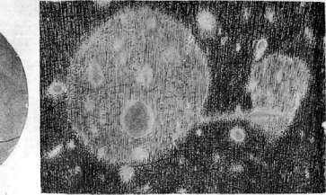Multiple Sclerosis: figure 2 from the 1928–1936 encyclopedia article