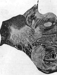 Multiple Sclerosis: figure 1 from the 1928–1936 encyclopedia article