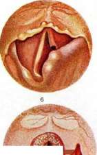 Epiglottis: figure 6 from the 1928–1936 encyclopedia article