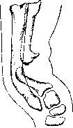 False Joint: figure 4 from the 1928–1936 encyclopedia article