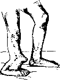 False Joint: figure 1 from the 1928–1936 encyclopedia article