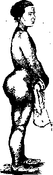 Trophoneuroses: figure 1 from the 1928–1936 encyclopedia article
