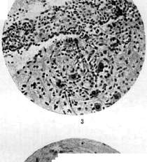 Encephalitis: figure 1 from the 1928–1936 encyclopedia article