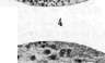 Encephalitis: figure 2 from the 1928–1936 encyclopedia article