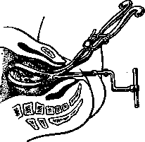 Obstetric Forceps: figure 5 from the 1928–1936 encyclopedia article