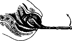 Obstetric Forceps: figure 3 from the 1928–1936 encyclopedia article