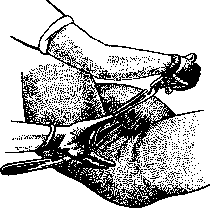 Obstetric Forceps: figure 2 from the 1928–1936 encyclopedia article
