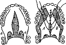Cleft Palate: figure 5 from the 1928–1936 encyclopedia article
