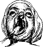 Cleft Palate: figure 2 from the 1928–1936 encyclopedia article