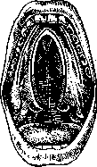 Cleft Palate: figure 3 from the 1928–1936 encyclopedia article