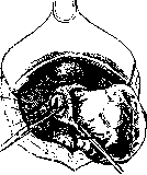 Hysterectomy: figure 4 from the 1928–1936 encyclopedia article